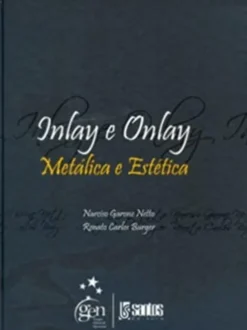 Inlay e Onlay - Metálica e Estética